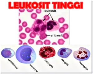 Inilah Cara Ampuh Mengobati Leukosit Tinggi Sampai Sembuh Total